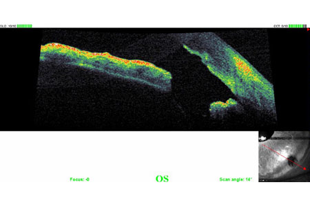 Iridotomia