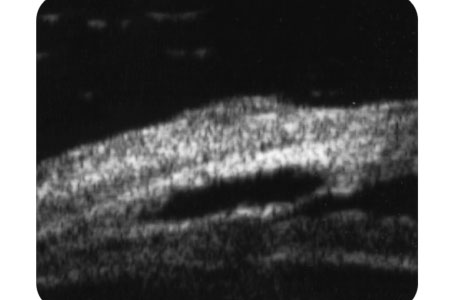 Viscocanalostomia